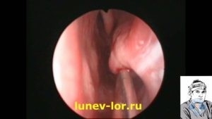 вазомоторный ринит, лазерная деструкция нижних носовых раковин