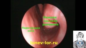 Медикаментозный ринит, состояние нижней носовой раковины после анемизации