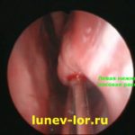 Вазомоторный ринит, лазерная деструкция нижних носовых раковин