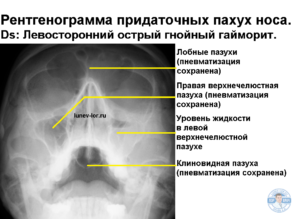 Гайморит. Синусит. Рентгенография придаточных пазух носа. Лечение гайморита без прокола.