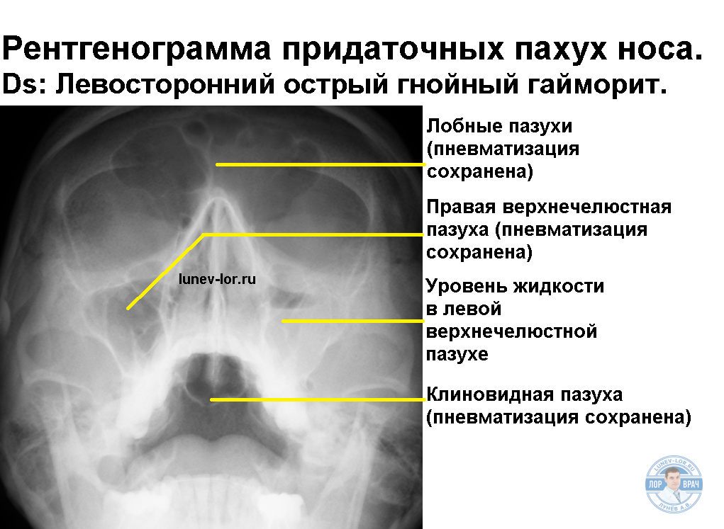 Рентген придаточных пазух носа синусит. Рентген придаточных пазух носа фронтит. Лобный гайморит рентген. Двухсторонний гнойный