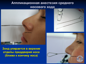 Зондирование пазух носа. Анестезия перед зондирование пазух носа.