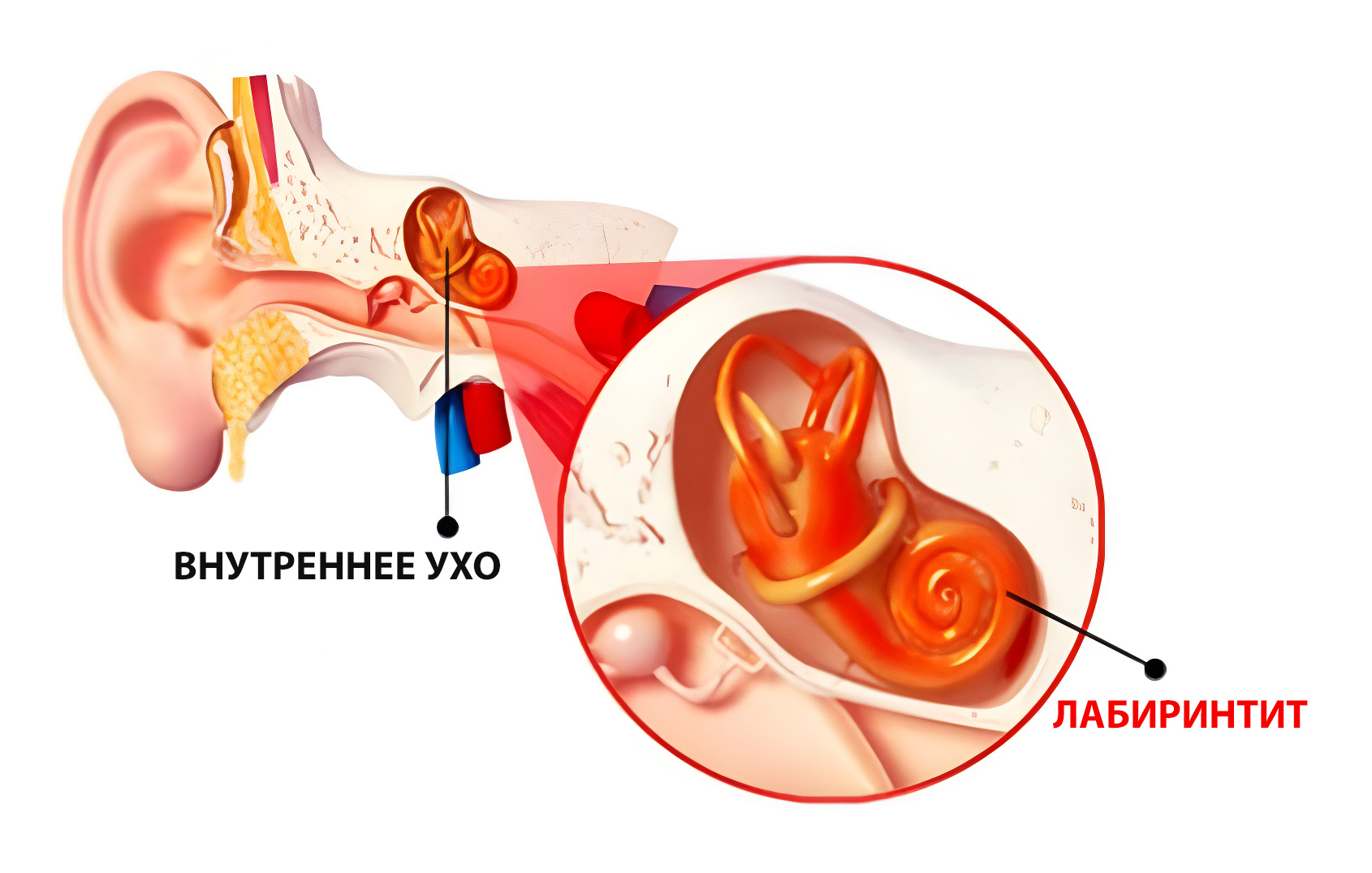 Нарушение внутреннего уха. Воспаление внутреннего уха лабиринтит. Воспаление среднего уха (лабиринтит);. Воспаление среднего уха лабиринтит симптомы. Воспалительные заболевания внутреннего уха (лабиринтиты)..