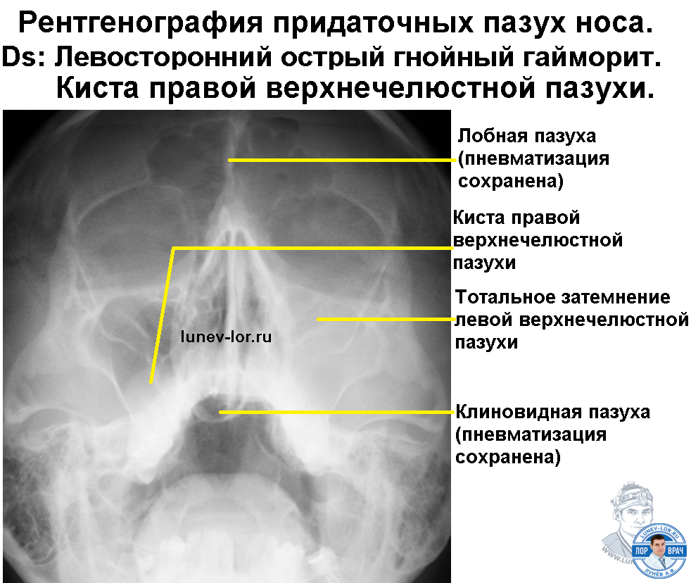 Рентген придаточных пазух носа синусит. Описание придаточных пазух носа рентген. Рентген пазух гайморит.