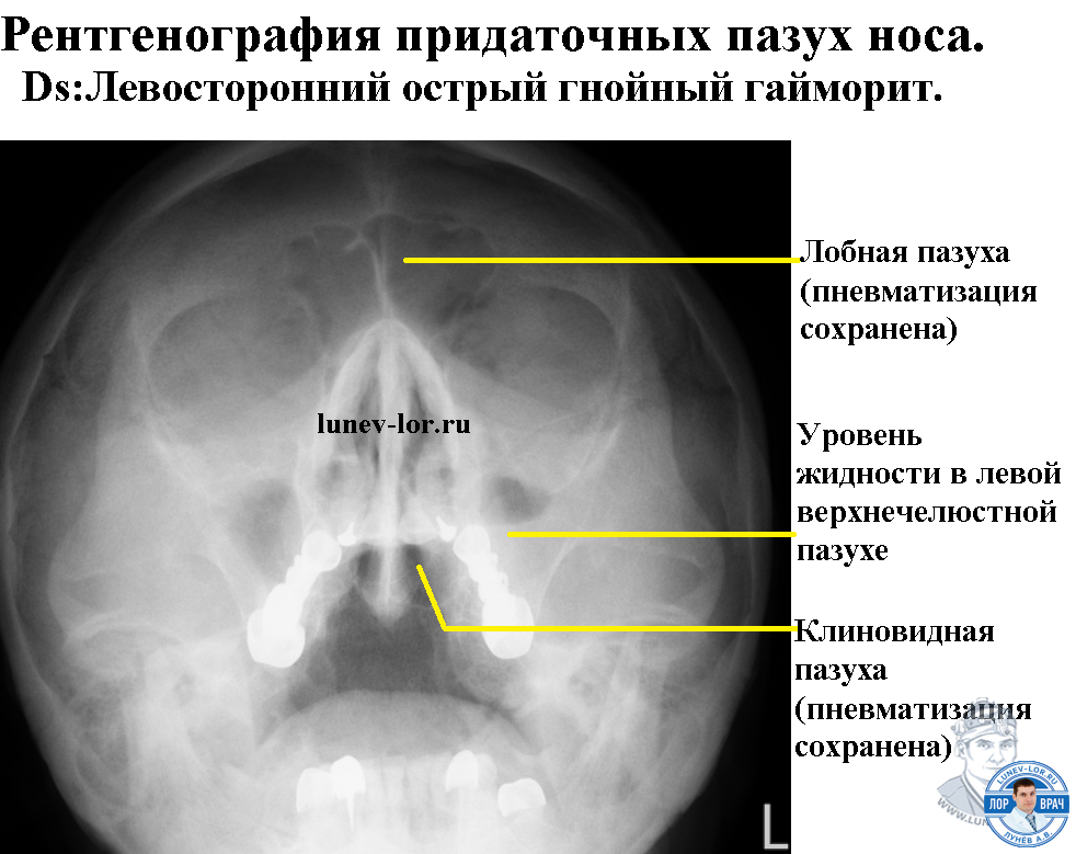 Пристеночный отек слизистой. Описание рентгена пазух носа. Рентген пазух носа в боковой проекции.