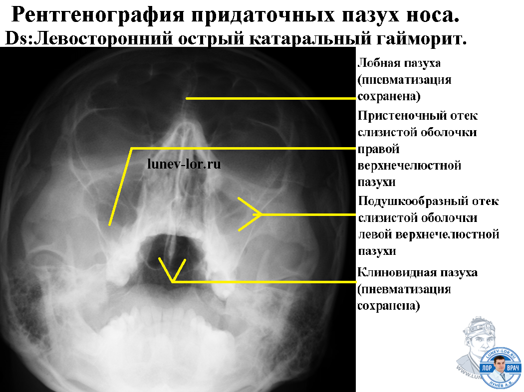 Описание придаточных пазух носа рентген. Рентген снимок придаточных пазух носа в норме.