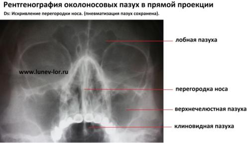 Рентгенография придаточных пазух носа