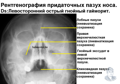 Гайморит. Синусит. Рентгенография придаточных пазух носа.