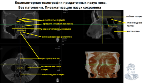 Компьютерная томография придаточных пазух носа здорового человека.