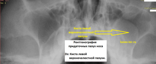 Рентген ППН киста С