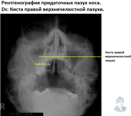 Рентгенография придаточных пазух носа. Киста верхнечелюстной пазухи.